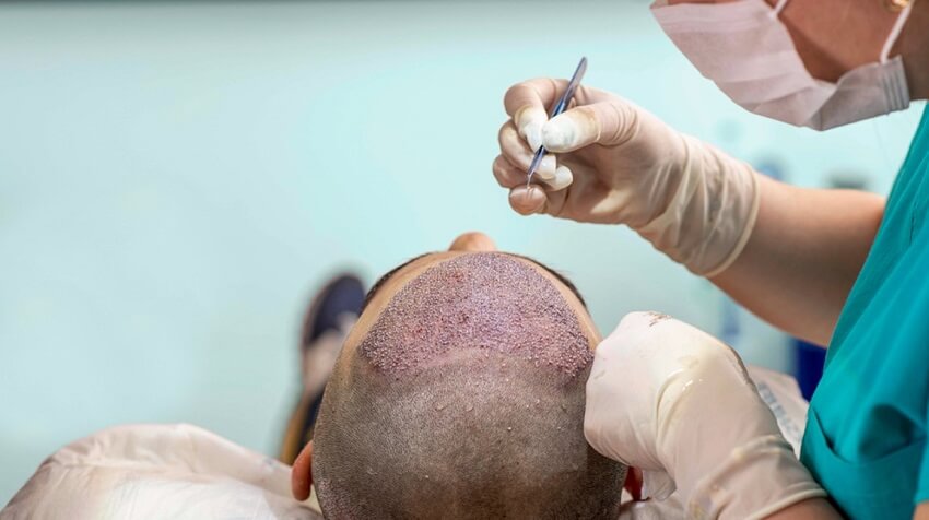 Basic Things to Do When Getting Ready for a Hair Transplant
